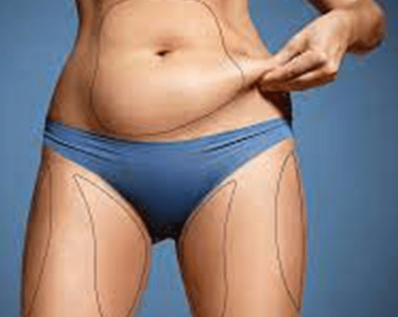 liposuction, an aesthetic surgery