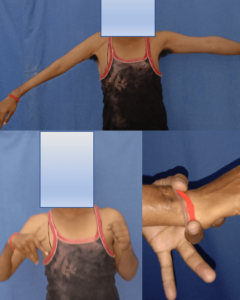 a patient's recovery after brachial plexus surgery at Yadav Super Specialty Hospital.