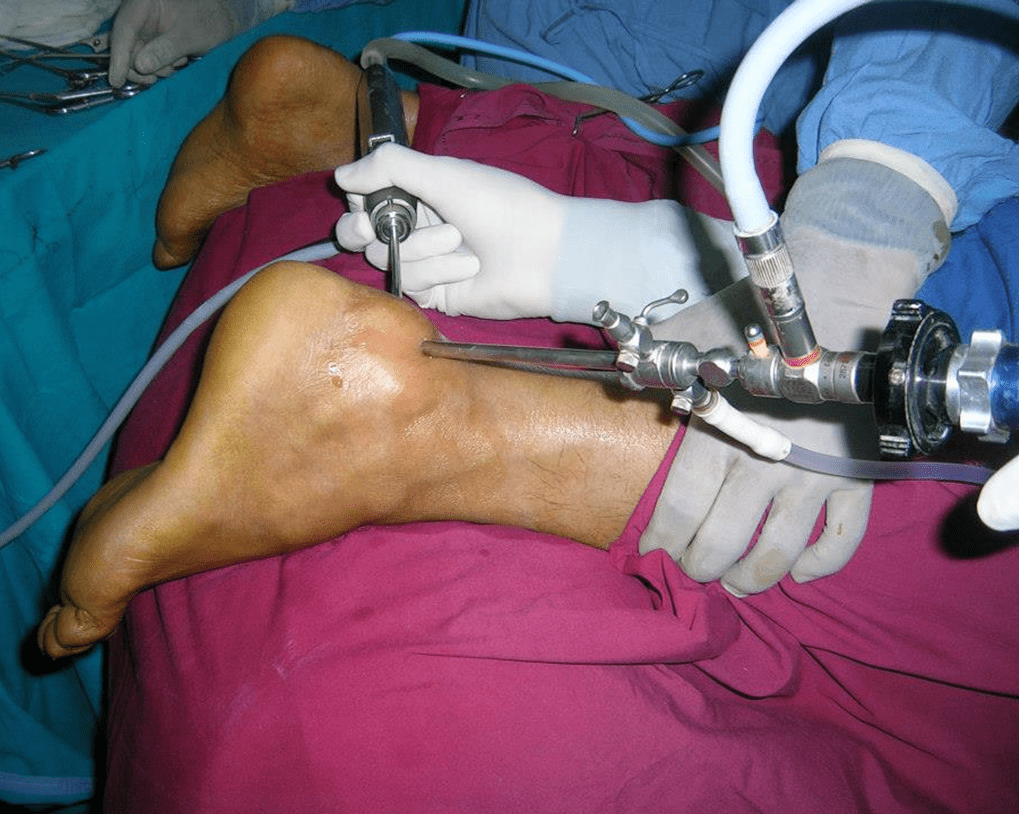 ankle arthroscopy procedure at Yadav Super Speciality Hospital