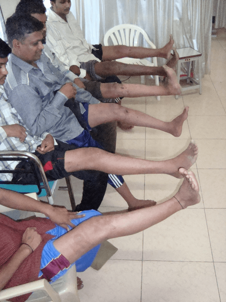 arthroscopic ACL reconstruction rehabilitation at Yadav Super Speciality Hospital.