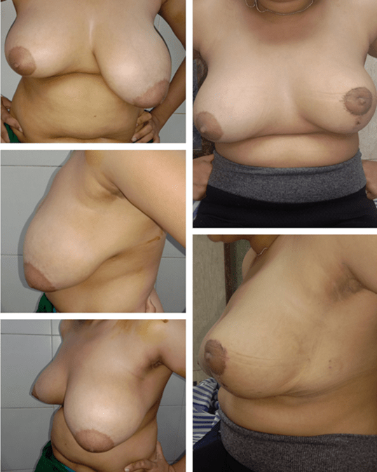 breast reduction surgery at Yadav Super Specialty Hospital