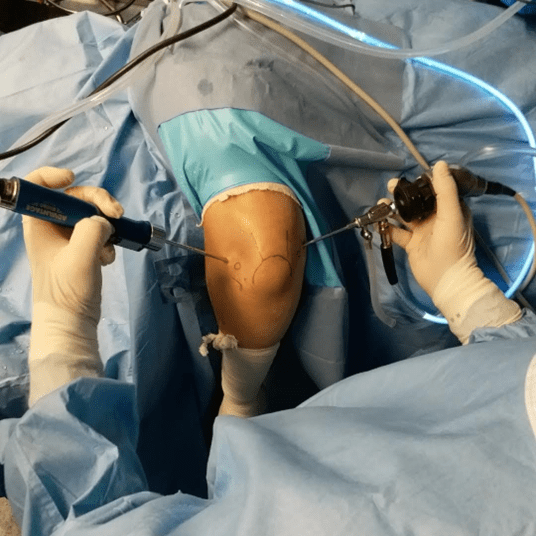 elbow arthroscopy procedure at Yadav Super Speciality Hospital