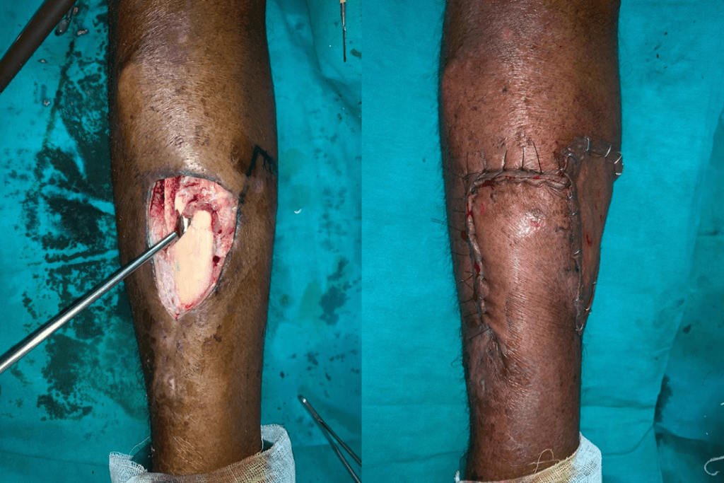 flap surgery in the lower limb for exposed bone at Yadav Super Specialty Hospital
