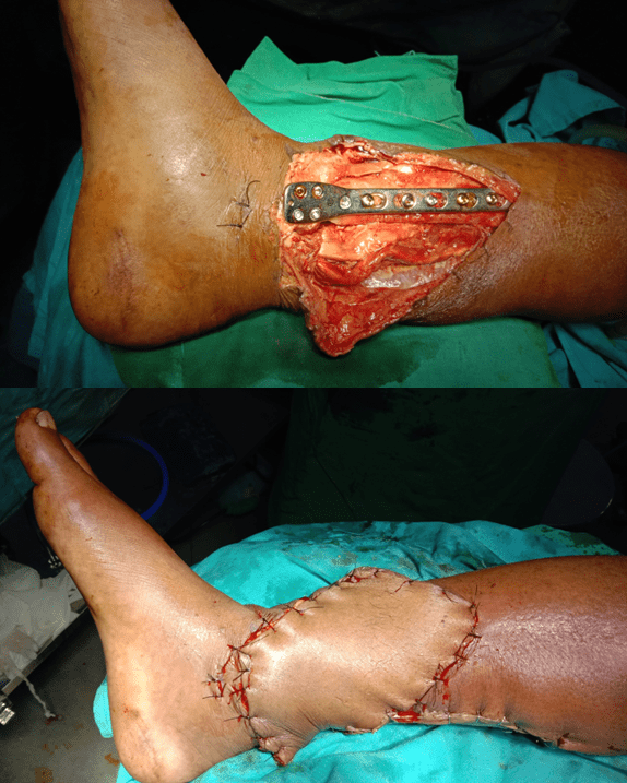 flap surgery in the lower limb for exposed implants at Yadav Super Specialty Hospital.