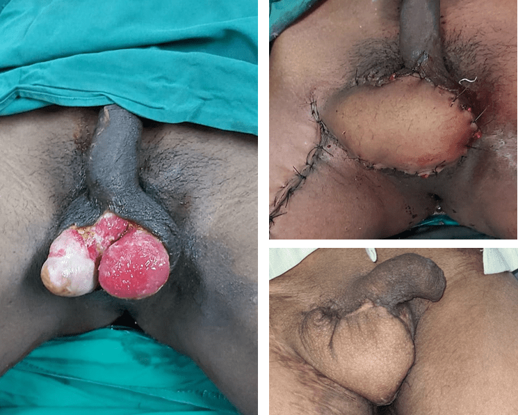 various genital surgeries including perineal tear surgeries, scrotum reconstruction, vaginal reconstruction, and vaginal rejuvenation surgeries at Yadav Super Specialty Hospital.