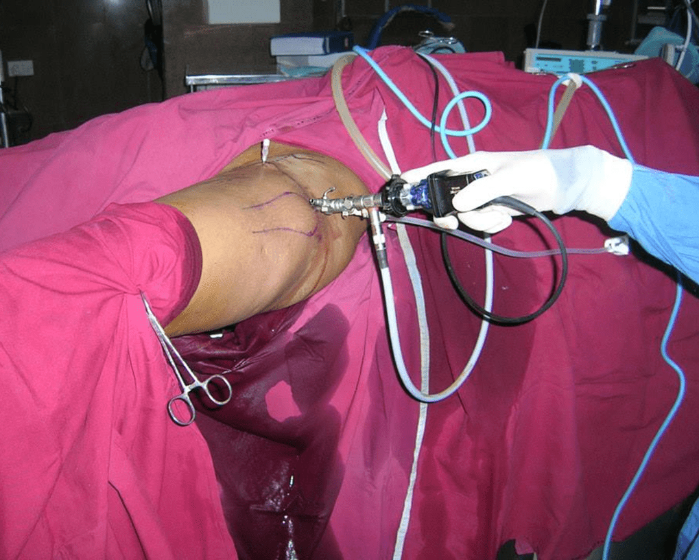 hip joint arthroscopy procedure at Yadav Super Speciality Hospital.