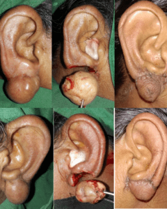 keloid excisions & reconstruction at Yadav Super Specialty Hospital