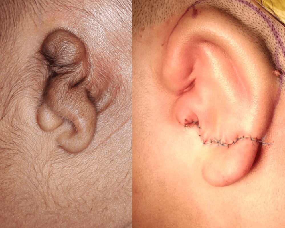 Reconstructed Ear From Rib Ear - Yadav Super Speciality Hospital