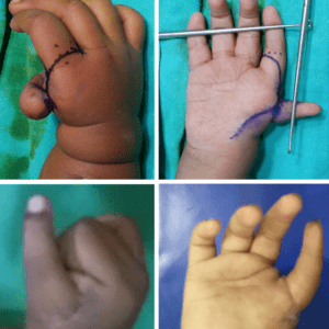 pollicization surgery for congenital absent thumbs or hypoplastic thumbs at Yadav Super Speciality Hospital.