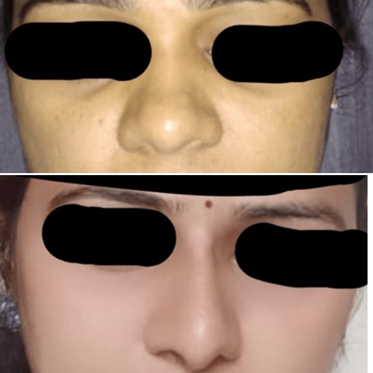 rhinoplasty procedure for aesthetic enhancement at Yadav Super Specialty Hospital.