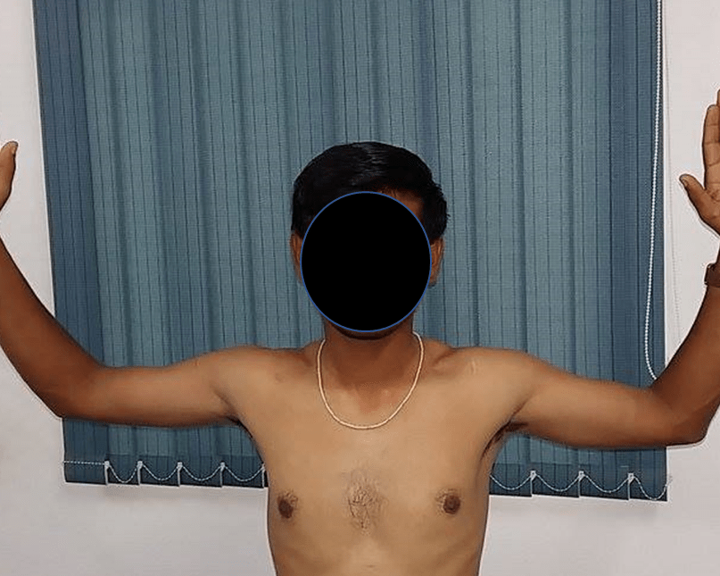 shoulder arthroscopy with Bankart repair at Yadav Super Speciality Hospital