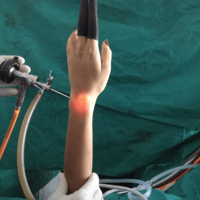 a patient undergoing wrist arthroscopy procedure at Yadav Super Speciality Hospital, where a small camera is inserted into the wrist joint to diagnose and treat various wrist conditions.