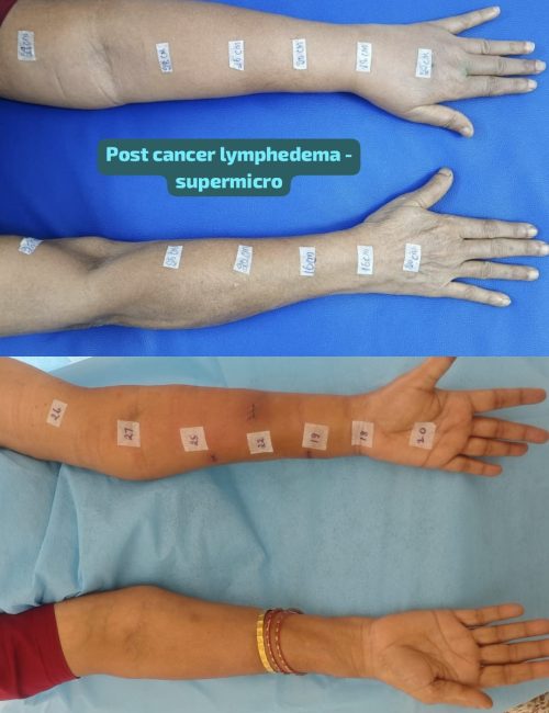 Before and after comparison of lower limb lymphedema treated surgically at Yadav Super Speciality Hospital