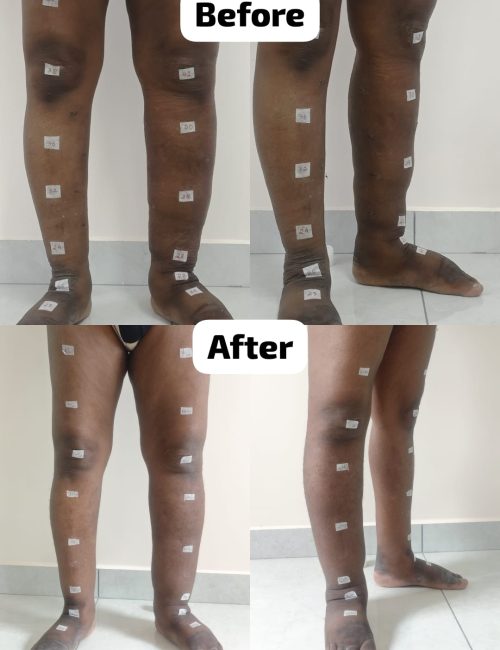 Before and after images of upper limb lymphedema treated with supermicrosurgical procedure at Yadav Super Speciality Hospital