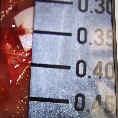 Microscope view of lymphedema supermicrosurgery at Yadav Superspeciality Hospital