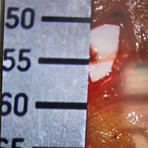 Supermicrosurgery for lymphedema at Yadav Superspeciality Hospital