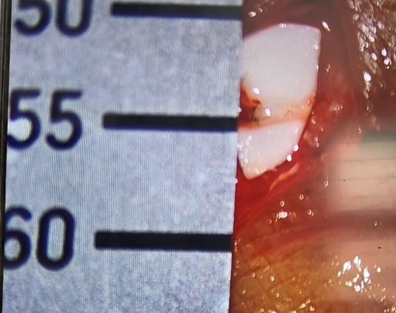 Supermicrosurgery for lymphedema at Yadav Superspeciality Hospital